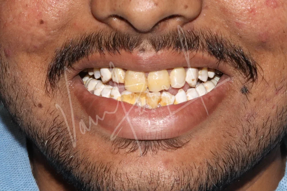 4 Unit Laminate Veneers - Image 1