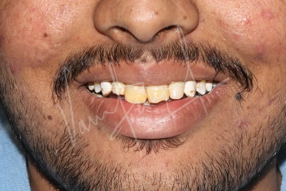 4 Unit Laminate Veneers - Image 2