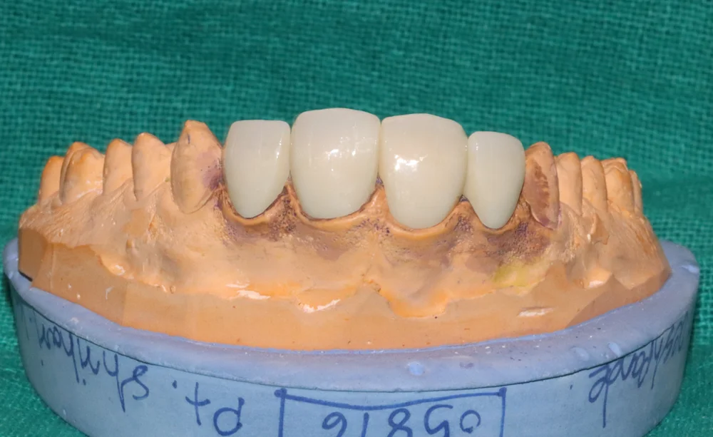 4 Unit Laminate Veneers