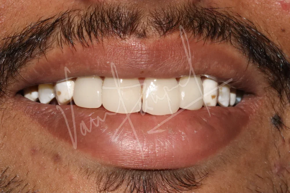 4 Unit Laminate Veneers - Image 4