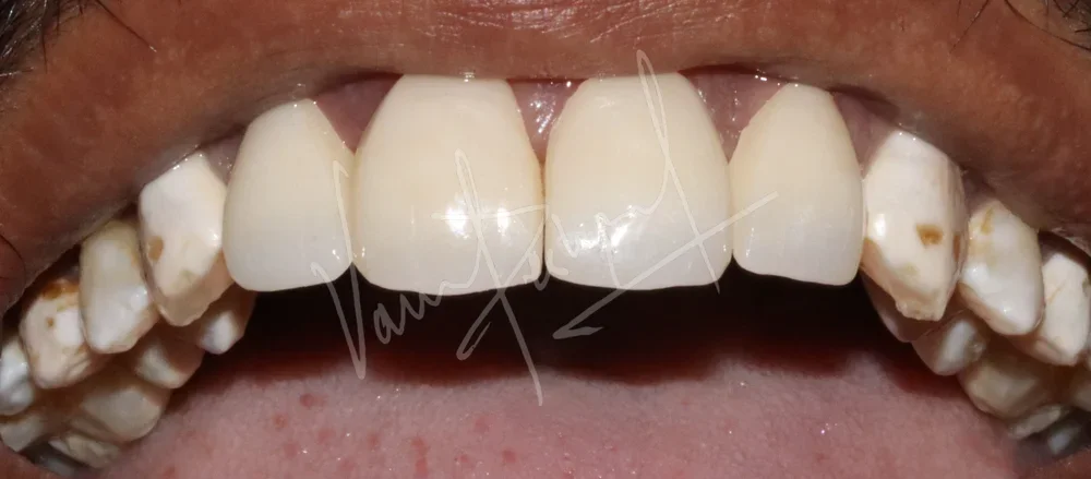 porcelain veneers on front teeth
