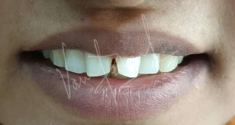 Anterior 2 unit All Ceramic Prosthesis - Image 1