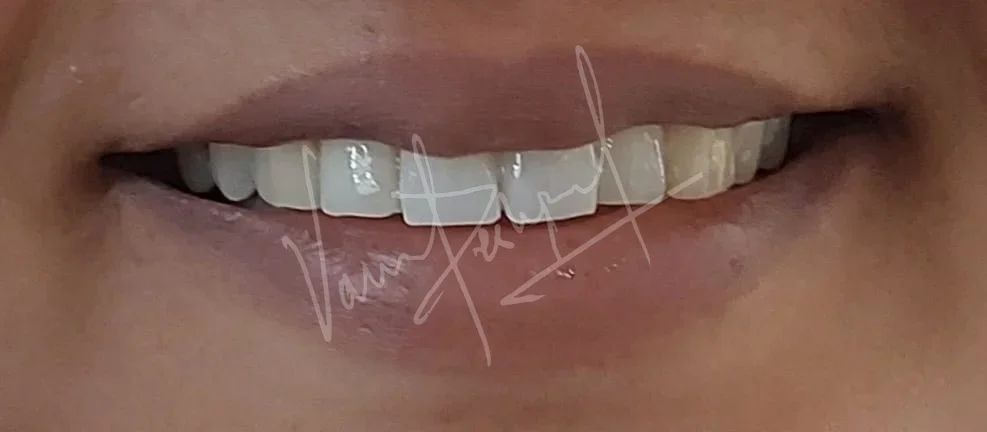 Anterior 2 unit All Ceramic Prosthesis