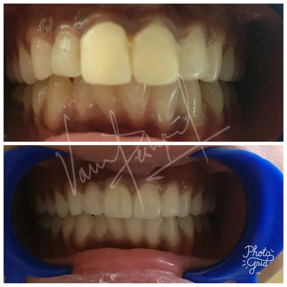 Anterior 3 Unit Zirconia