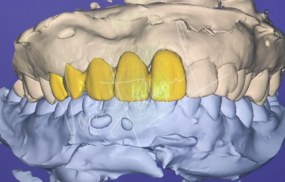 Anterior Zirconia Bridge - Image 3