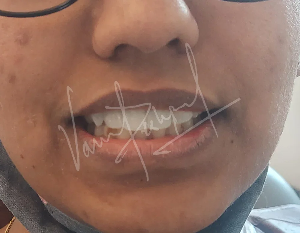 Anterior Zirconia Bridge - Image 4