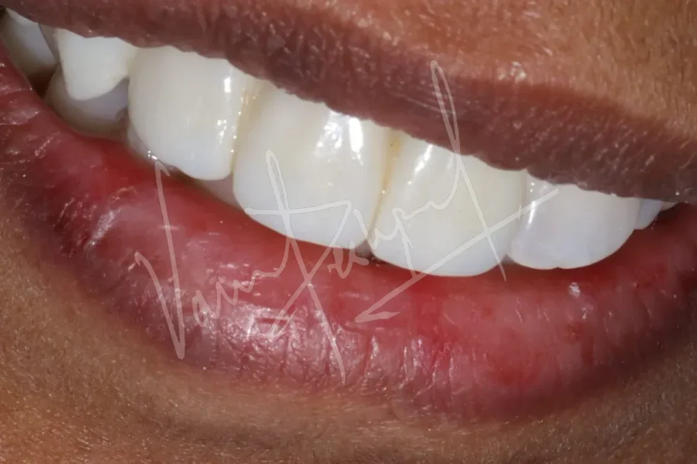 Anterior Zirconia Bridge