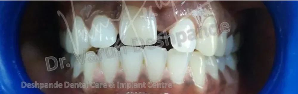Anterior Zirconia Prosthesis - Image 1