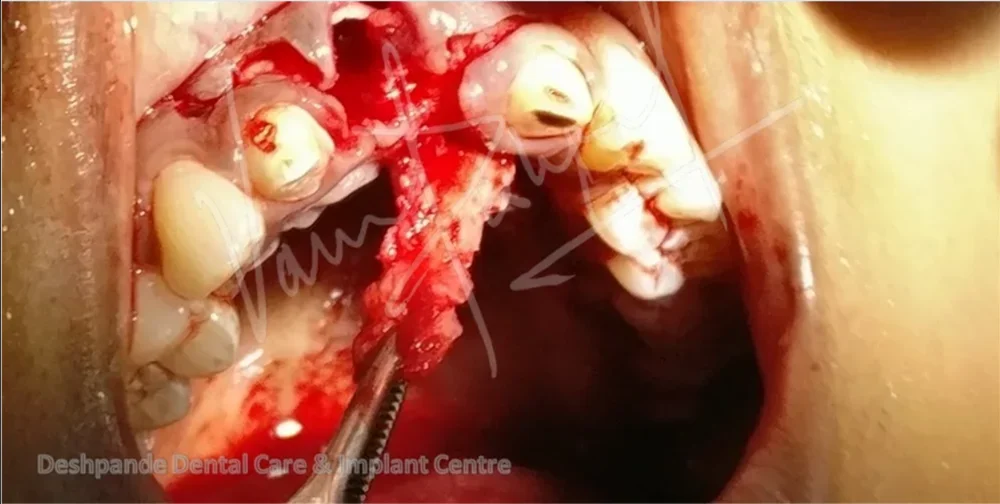 Anterior Zirconia Prosthesis - Image 4