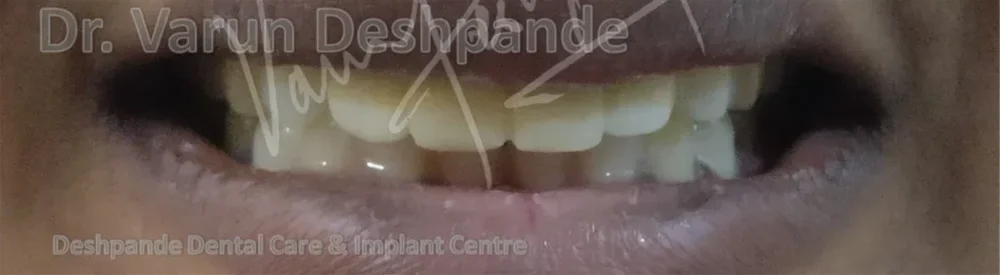 Anterior Zirconia Prosthesis - Image 5