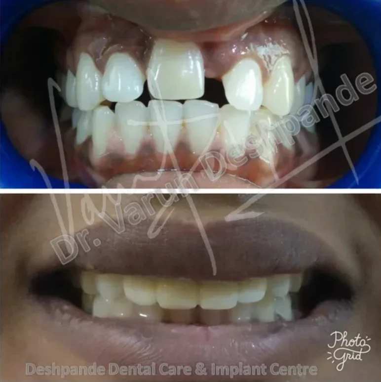 Anterior Zirconia Prosthesis