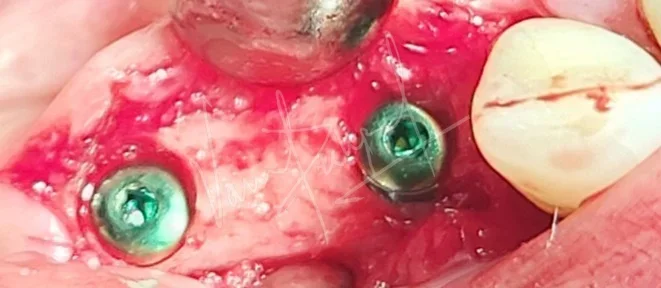 Dental Implants - Image 10