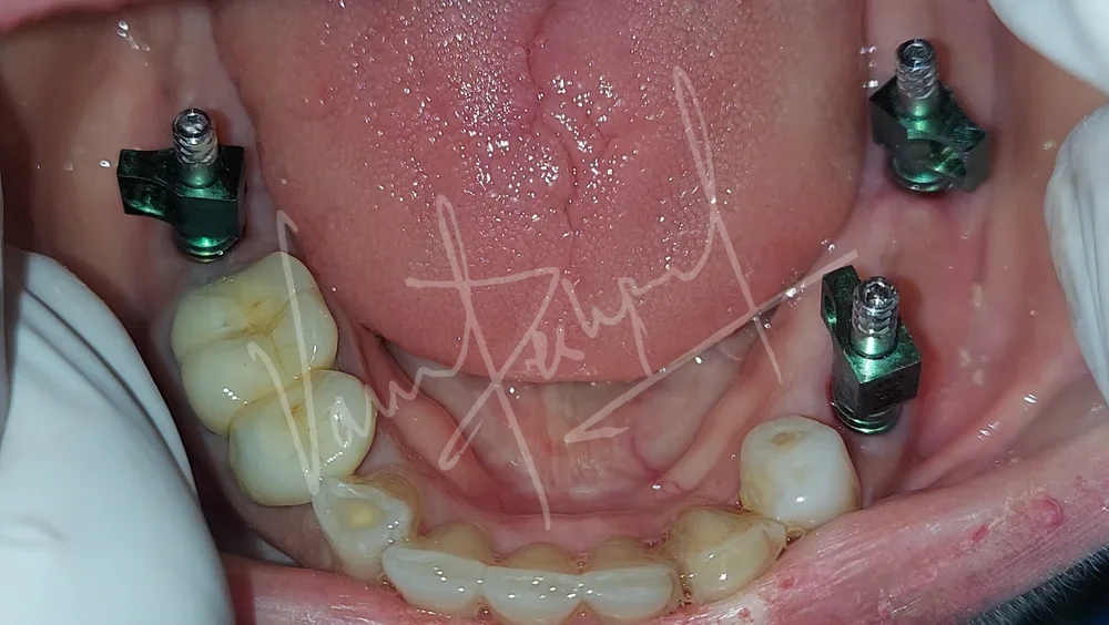 Dental Implants - Image 14