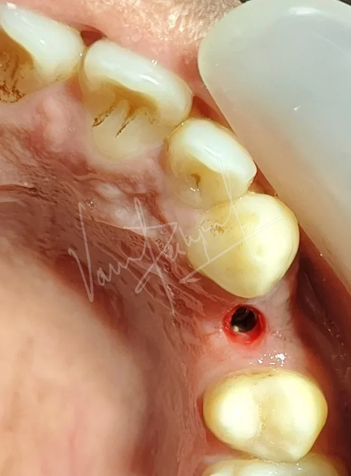 Dental Implants - Image 15