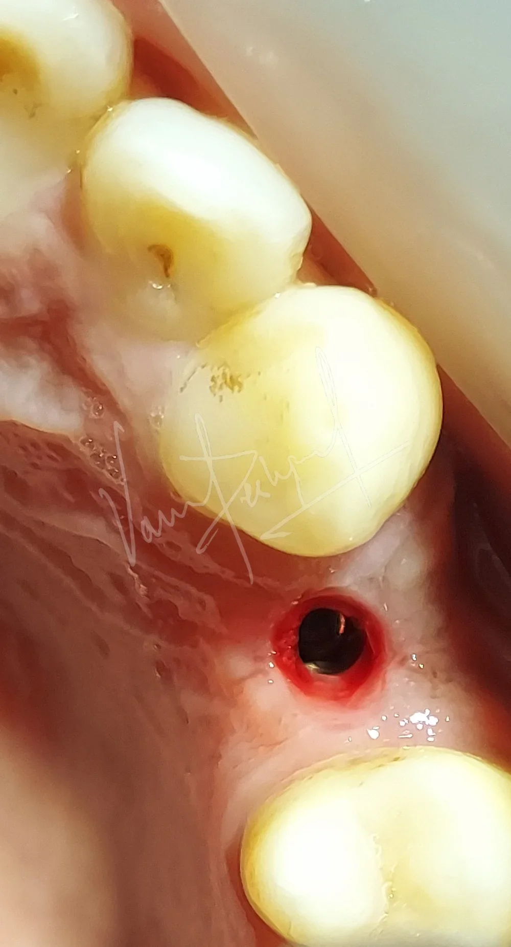 Dental Implants - Image 16