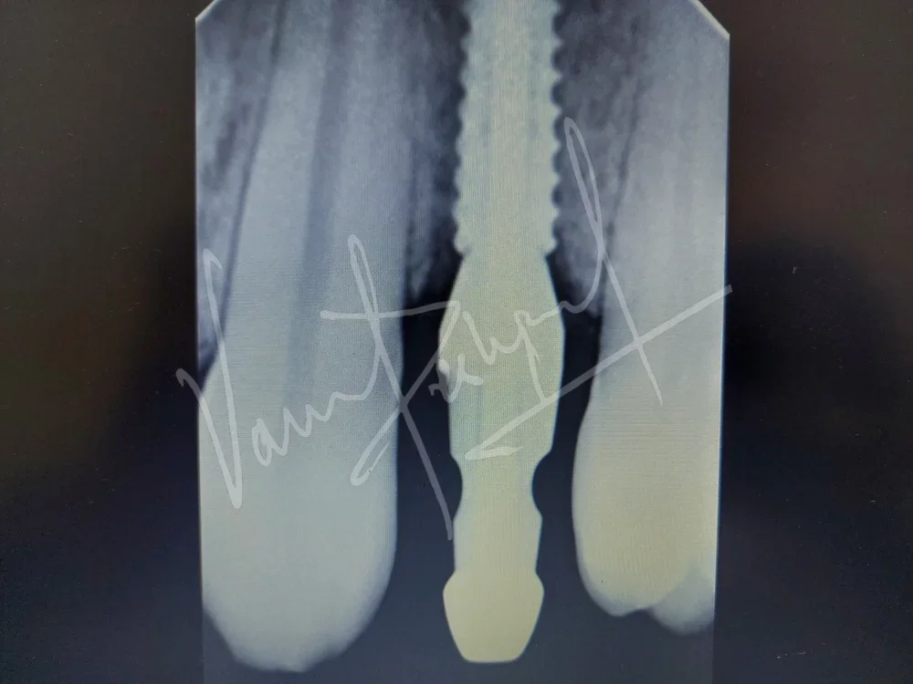 Dental Implants - Image 17