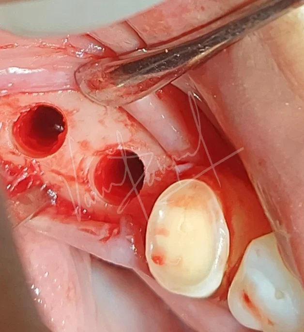 Dental Implants - Image 18