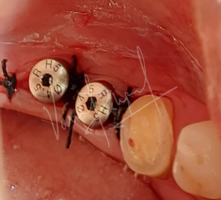 Dental Implants - Image 20