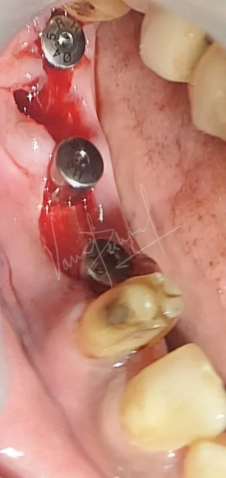 Dental Implants - Image 21