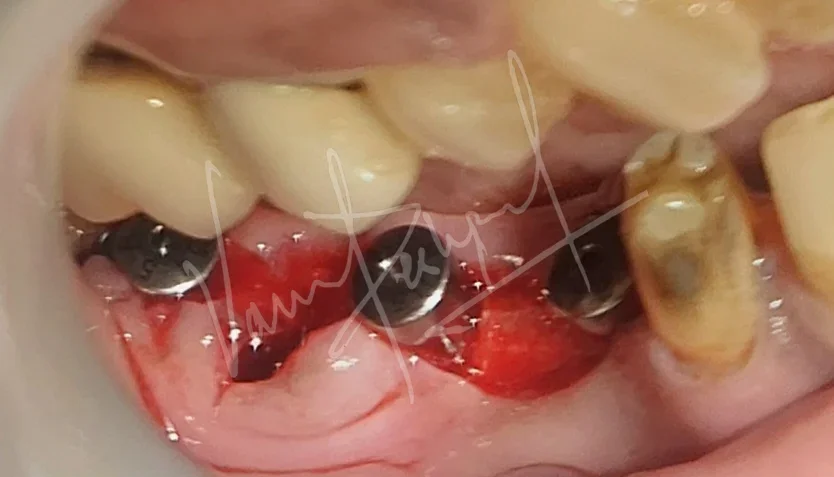 Dental Implants - Image 22