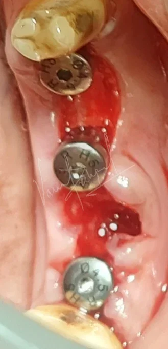 Dental Implants - Image 23