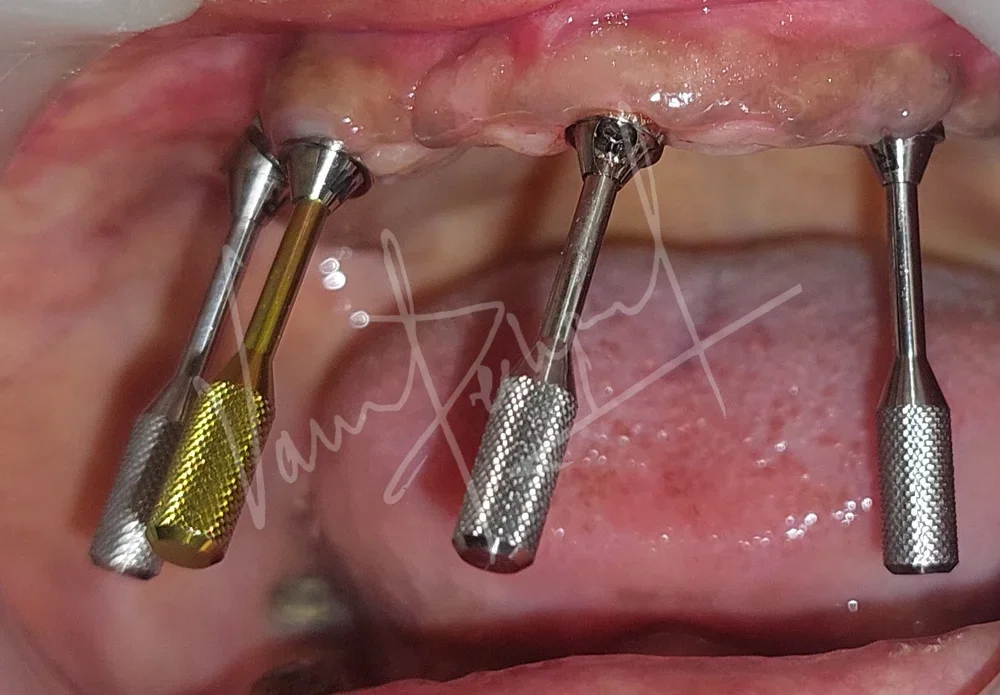 Dental Implants - Image 24