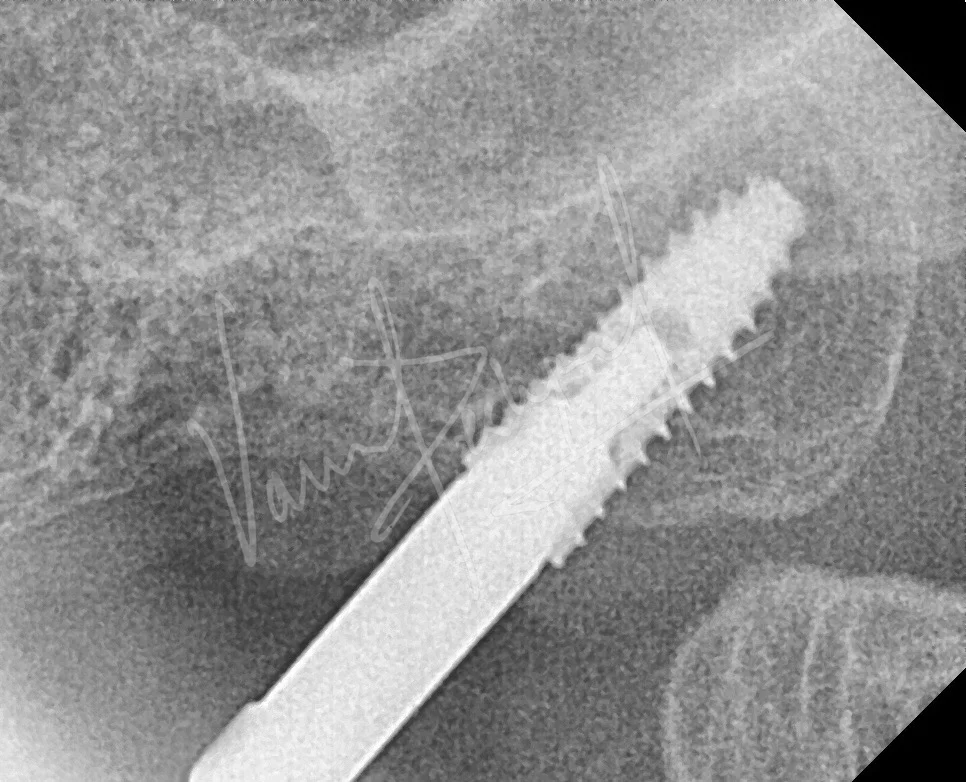 Dental Implants - Image 25