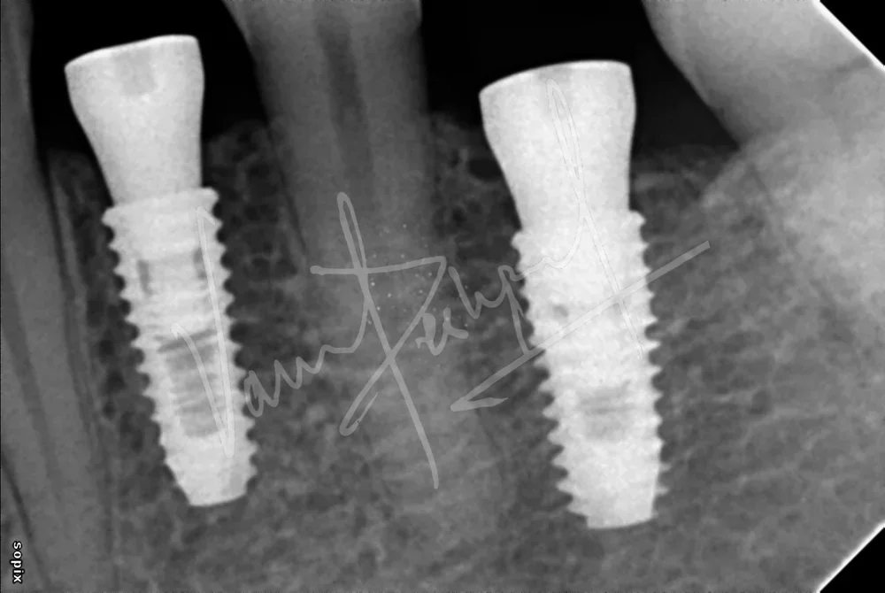 Dental Implants - Image 29