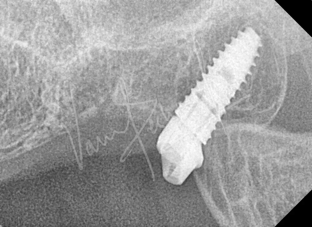 Dental Implants - Image 31