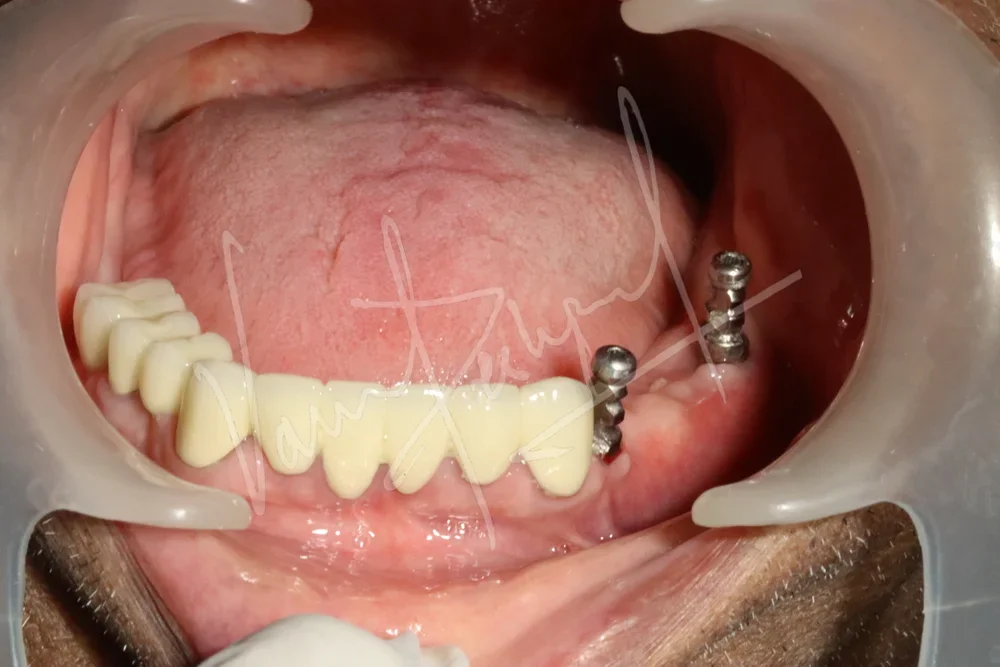 Dental Implants - Image 33