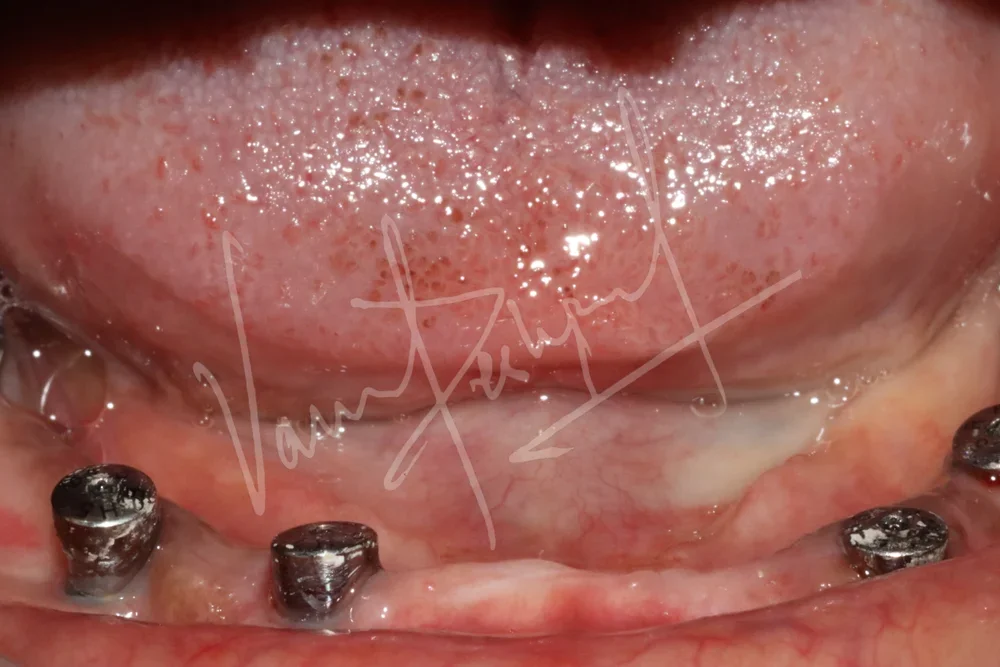 Dental Implants - Image 36