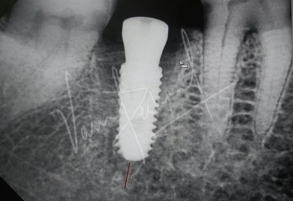 Dental Implants - Image 37