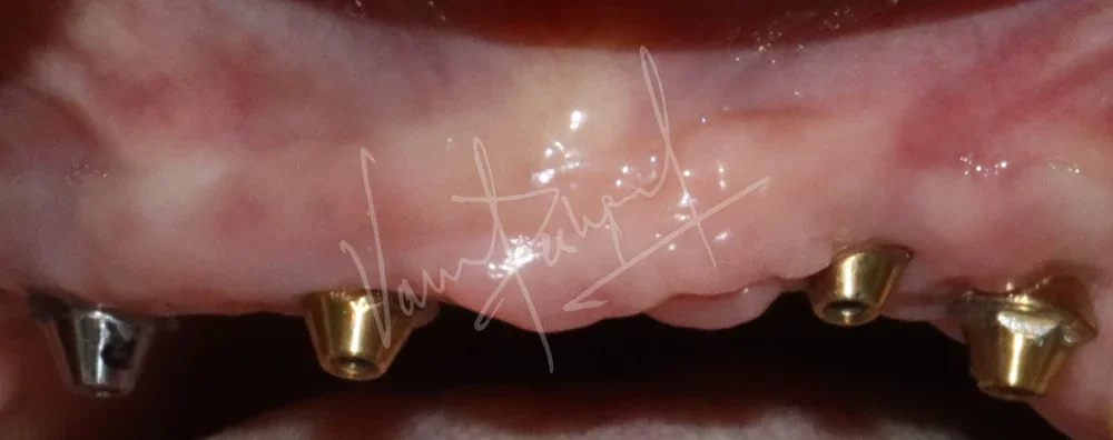 Dental Implants - Image 38