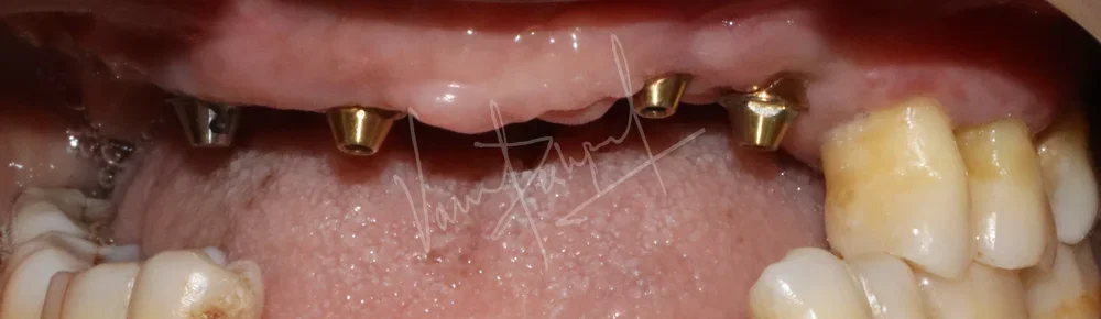 Dental Implants - Image 39