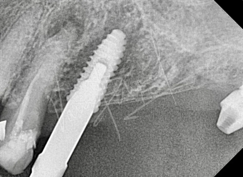 Dental Implants - Image 4