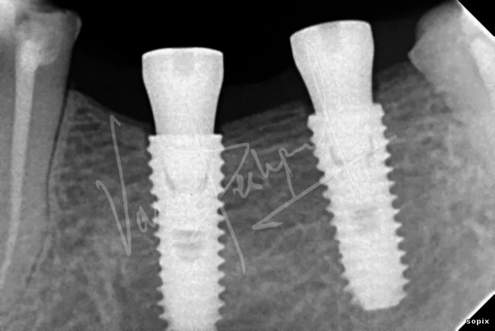 Dental Implants - Image 5
