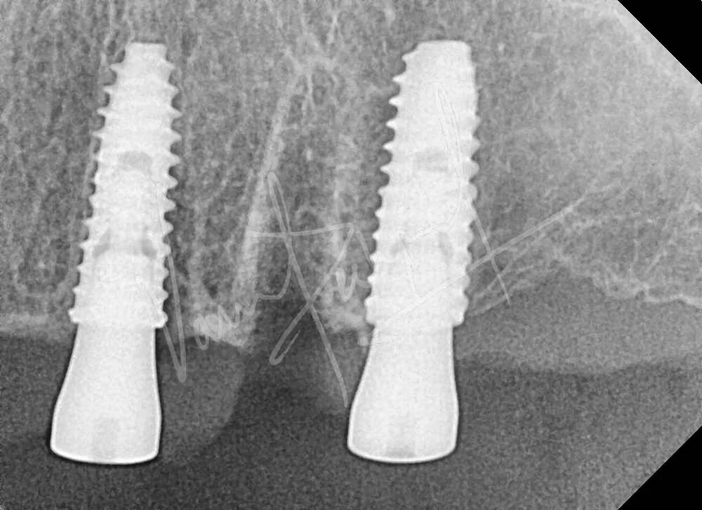 Dental Implants - Image 6