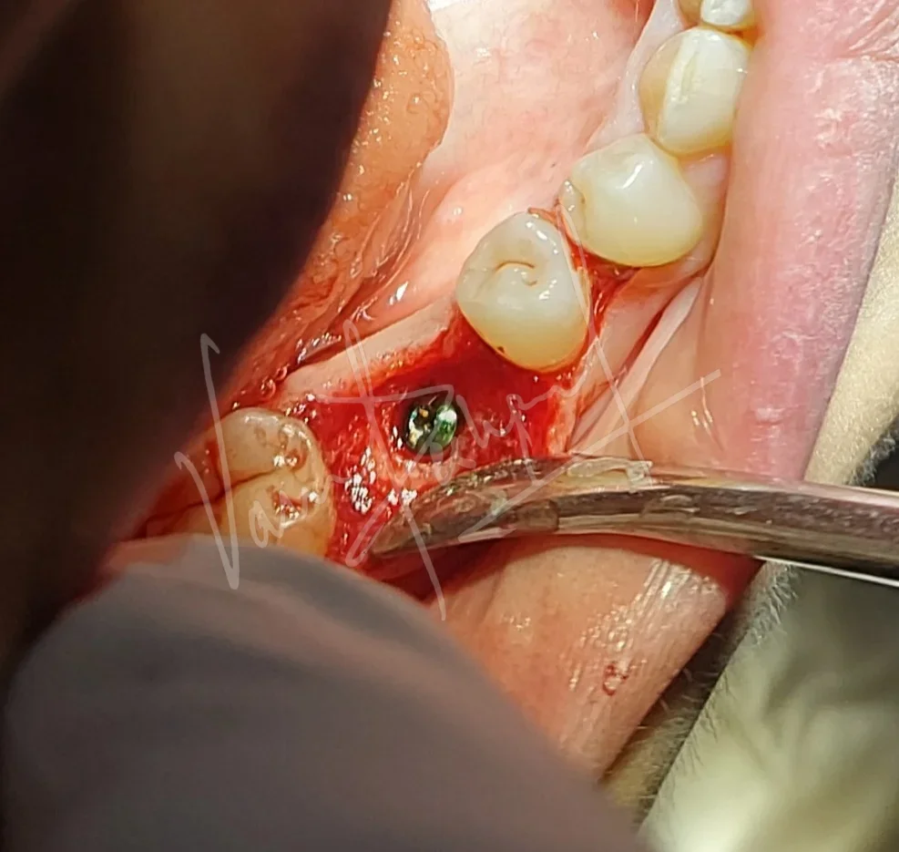 Dental Implants - Image 9