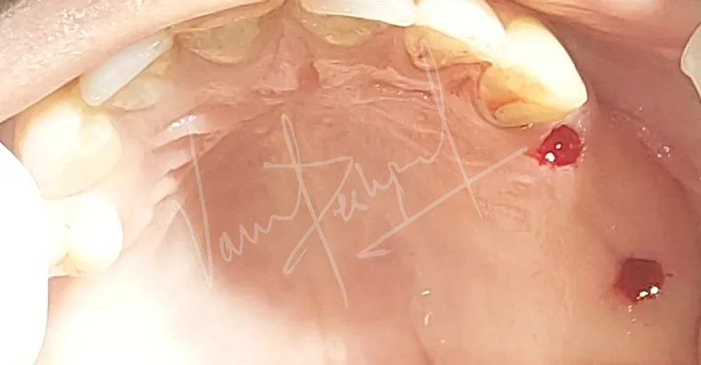 Flapless Guided Implant Surgery - Image 4
