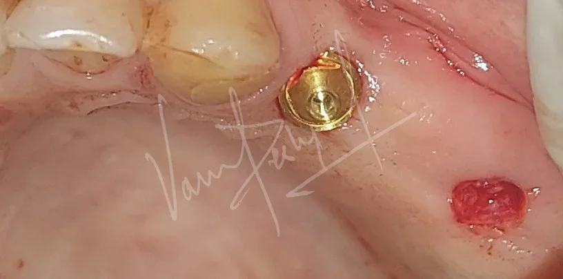 Flapless Guided Implant Surgery - Image 5