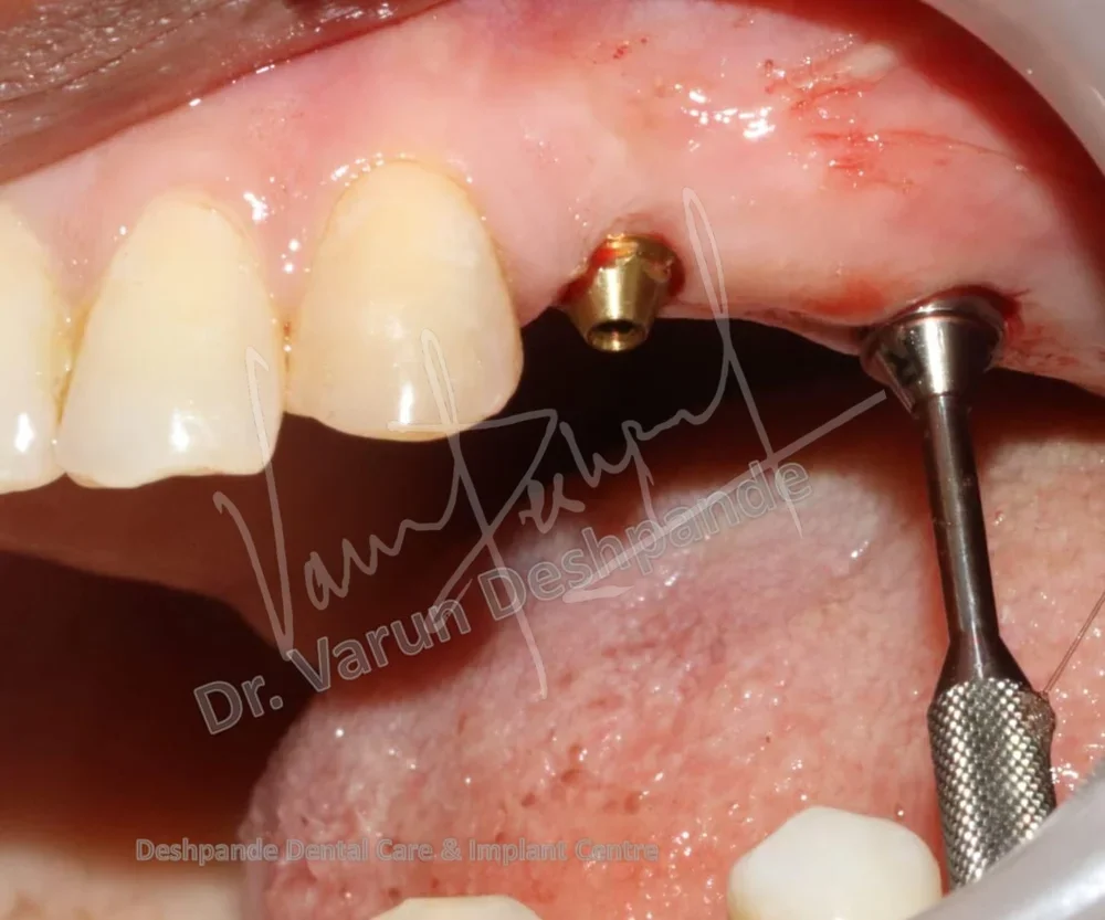 Flapless Guided Implant Surgery