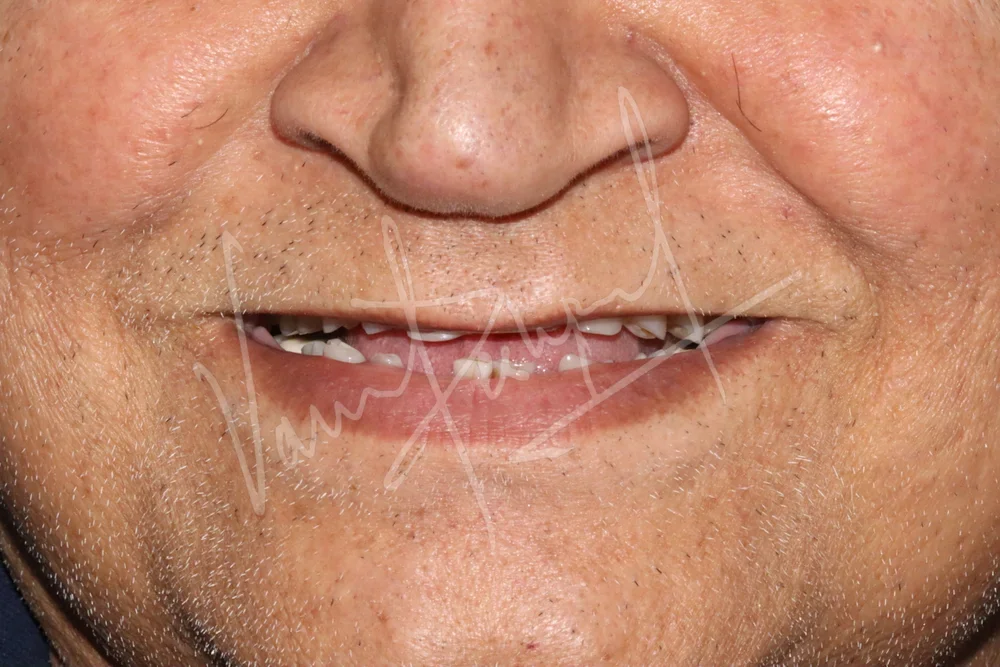 FMR using All Ceramic Prosthesis - Image 1