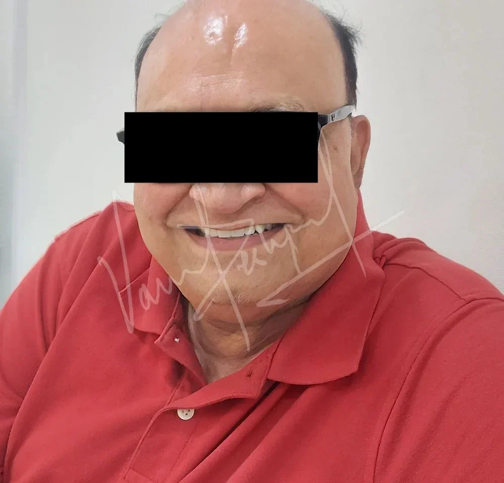 FMR using All Ceramic Prosthesis