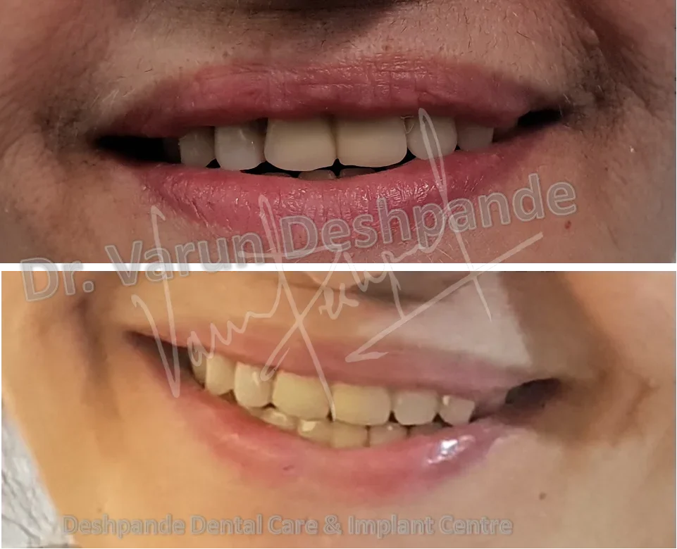 FMR using Crown and Bridge and Precision Attachment