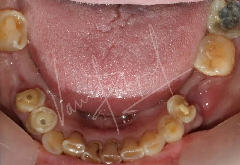 FMR using Metal Ceramic Prosthesis - Image 3