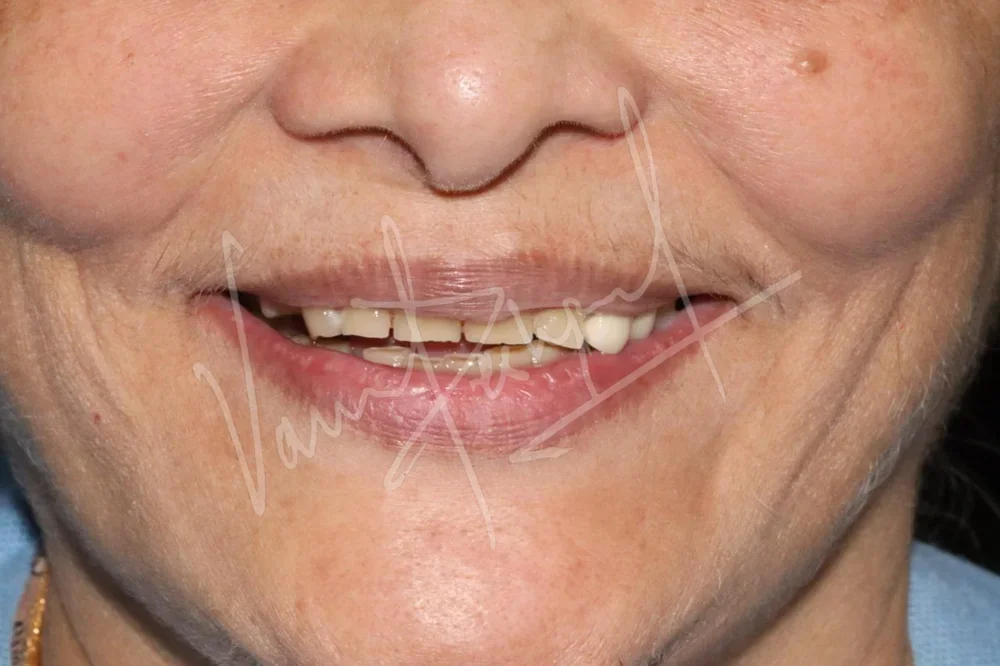 FMR using Metal Ceramic Prosthesis - Image 4