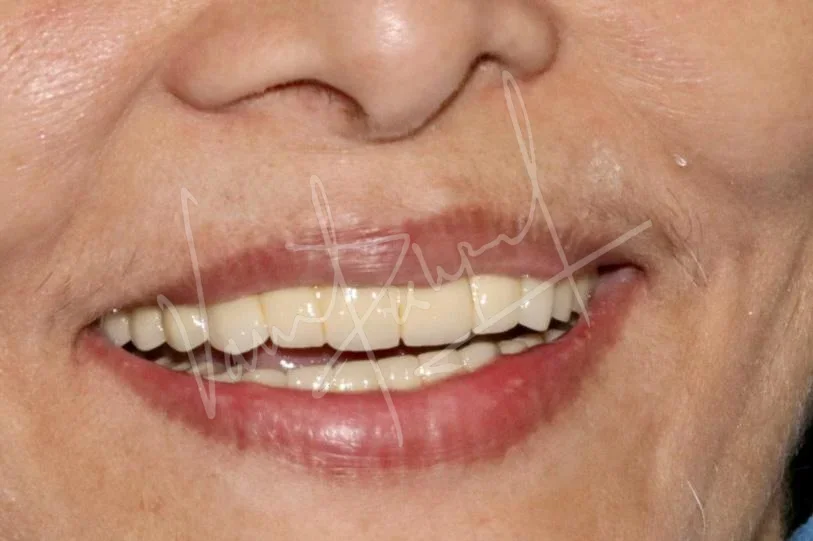 FMR using Metal Ceramic Prosthesis