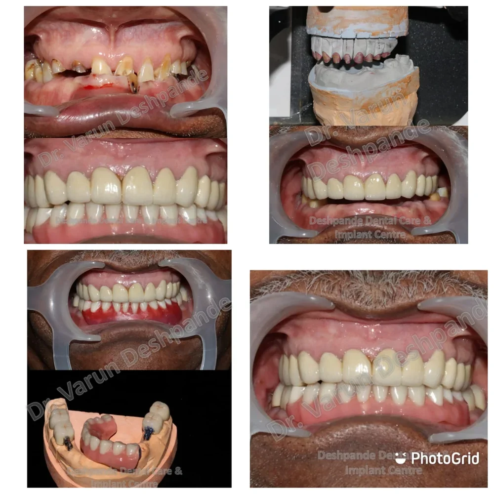 FMR using Precision Attachment with Crown and Bridge and Dental Implants