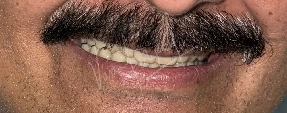 FMR using Zirconia Prosthesis