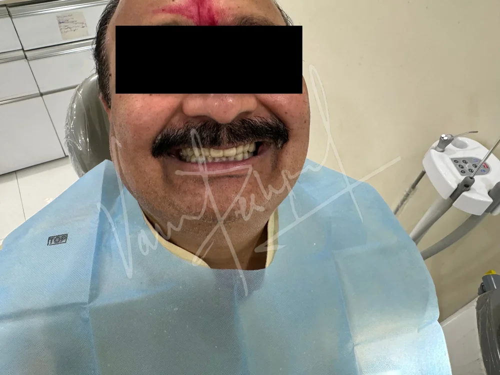 FMR using Zirconia Prosthesis - Image 11